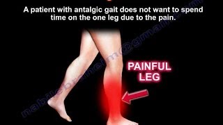 Antalgic Gait  Everything You Need To Know  Dr Nabil Ebraheim [upl. by Web43]