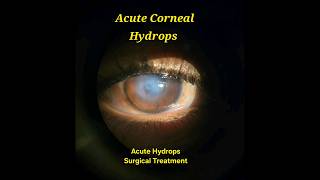 Acute Corneal Hydrops Surgical Draining [upl. by Allerym]