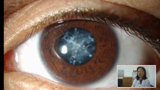 Retropupillary irisclaw IOL in ectopia lentis in Marfan syndrome – Video abstract 106382 [upl. by Kliment]