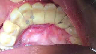 Houston Cosmetic DentistWorst Tartar I have seen Watch how we remove it [upl. by Zia418]