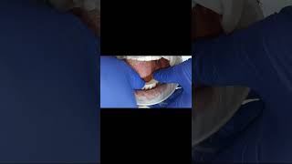 Fixed full set of new teeth with dental implants in 5 days with cutting edge technology in India [upl. by Sitelc]