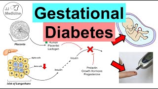 Gestational Diabetes Pregnancy Diabetes  Causes Risk Factors Symptoms Consequences Treatment [upl. by Ylloh]