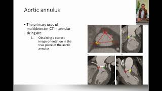 Lecture 2 CT TAVI planning The basics [upl. by Tyne]