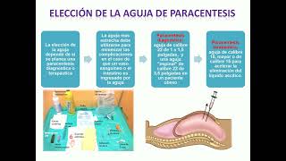 Paracentesis Abdominal [upl. by Nilya]