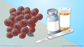 Treating Melanoma [upl. by Callean]