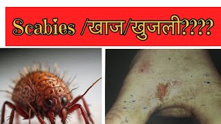 स्केबीज खाज  खुजली scabies scabies scabiestreatment [upl. by Audie]