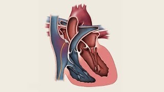 Mayo Clinic Minute What you need to know about patent foramen ovale [upl. by Misab]