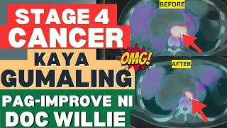 Stage 4 Cancer Kaya Pa Gumaling By Doc Willie Ong [upl. by Anuahsar]