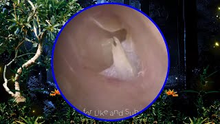 Tympanic membrane perforation and postoperative debridement for cholesteatoma 5 [upl. by Hew310]