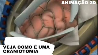 Veja como é uma Craniotomia em 3D  Neurologia  Medicina Geral [upl. by Ericksen]