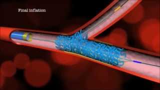 Main Branch Bifurcation Stent quotPROVISIONALquot by Advanced Bifurcation Systems [upl. by Norre]