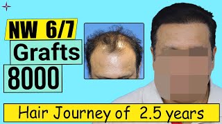 Hair Transplant Result in 25 Years 8000 Grafts Grade 67  Eugenix by Expert Hair Surgeons [upl. by Nwahsram283]