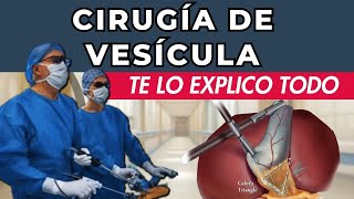 CIRUGÍA DE VESÍCULA  Colecistectomía Laparoscópica  Lo que debes saber [upl. by Koziel589]