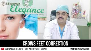 Crows Feet Correction  Botox Treatment  Surat Ahmedabad Gujarat Mumbai Pune Maharashtra [upl. by Essirahc758]