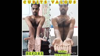 quotSuccessful Cubitus Valgus correction by Dr Manish Bansal at Elite Defence Academy Meerutquot [upl. by Theodoric]