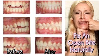 How To Fix An Open Bite Naturally No Braces No Surgery [upl. by Gayn200]