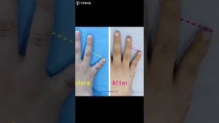 brachydactyly 短指症手術 短指症 단지증 단지증수술 단지증수술후기 braquidactilia عضدي الأصابع брахидактилия [upl. by Sutelc926]