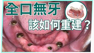 【怕植牙失敗？植牙專業朱裕華醫師來救援！EP6】全口植牙該如何重建？台中牙科－游牙醫解析如何處理植牙失敗問題 如何處理 專業牙醫診所 [upl. by Xuerd]