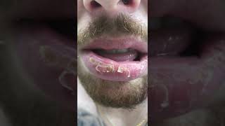 How To Cure Lip Licking Cheilitis [upl. by Nialb]