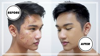 How to Cover Mens ACNE amp SCARS  Mens Makeup Tutorial [upl. by Ewold]