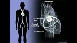 Coronary Arteriography  Coronary Angiography  Definition Procedure Uses Benefits [upl. by Lolita452]