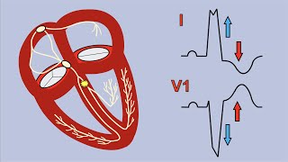 Left Bundle Branch Block and Sgarbossas Criteria [upl. by Ayrotal]