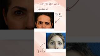 Lifting facial antes y después [upl. by Rubel]