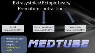 ECGs abnormal rhythms Extrasystoles [upl. by Naeloj471]