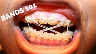 How Do Braces Bands Work Elastics [upl. by Sammy632]