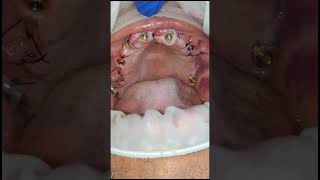 All on 6 maxilla all on 5 mandibledental implant healing and healing cap removal 2nd day shorts [upl. by Aihsrop]