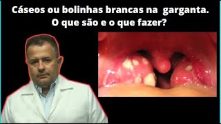 Cáseos ou bolinhas brancas na garganta O que são e o que fazer [upl. by Assirod]