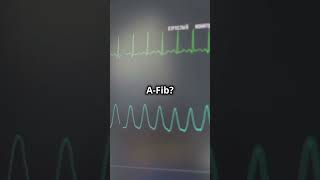 NEVER Miss These AFiB Signs on an ECG [upl. by Nuawd]