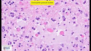 Pilocytic astrocytoma microscopy  Talking slide [upl. by Atoked]