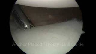 Arthroscopic Bankart Labral Repair [upl. by Ahtnamys]