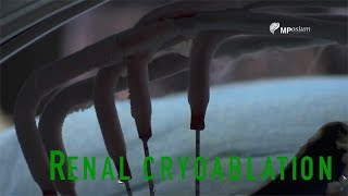 Renal Cryoablation [upl. by Agnella721]