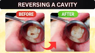 How To Reverse Cavities Naturally At Home Works🦷✨ naturalremedies dentalhealth toothpaste [upl. by Ayn]