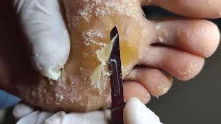 Removing Extremely Hard Foot Callus 🦶 The right way to remove foot callus FULL TREATMENT 04 [upl. by Eannyl]