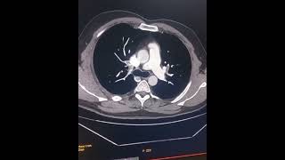 CT pulmonary embolism [upl. by Atsahc]