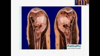 Histopathology BoneOsteosarcoma [upl. by Dhiman]