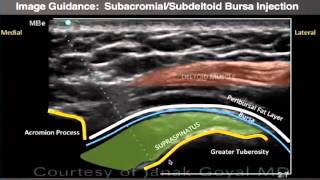 Webinar UltrasoundGuided Shoulder Injections Part 1 [upl. by Alleahcim]