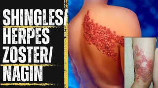 Shingles Causes Prevention amp Treatment  Herpes Zoster  Nagin [upl. by Okim]