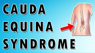 Cauda Equina Syndrome [upl. by Htebzile]