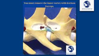 Hemilaminectomy in dogs [upl. by Hamian]