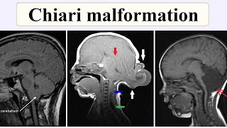 Chiari malformation [upl. by Cinimmod]