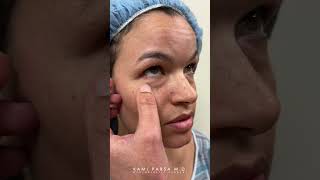 Should You Remove CHEEK FILLER Before Trifecta Lift  Lower Eyelid Surgery with Dr Kami Parsa [upl. by Yeliah340]