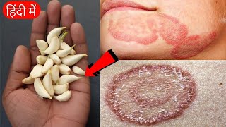 3 दिन  पुराने से पुराने दाद खाज खुजली को दूर करने का सबसे सफल उपाय  Ringworm Treatment Naturally [upl. by Nilekcaj]