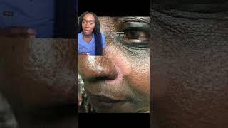 The Hidden Cause of Your Flaky ScalpDandruff Seborrheic Dermatitis Explained [upl. by Huldah]