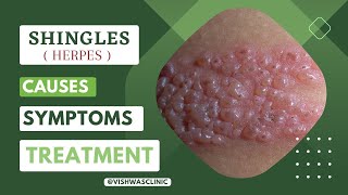 SHINGLES Herpes zoster Diseases  Causes Symptoms and Treatment [upl. by Belinda643]