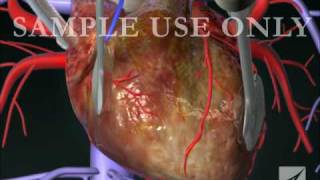 Coronary Artery Bypass Graft CABG Procedure [upl. by Elleynod]