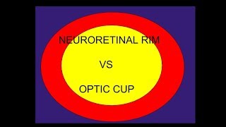 Optic cup Vs Neuro retinal rim [upl. by Mastic]